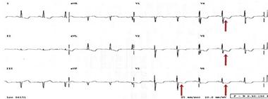 致命的主动脉夹层,主动脉夹层最危险的生命杀手