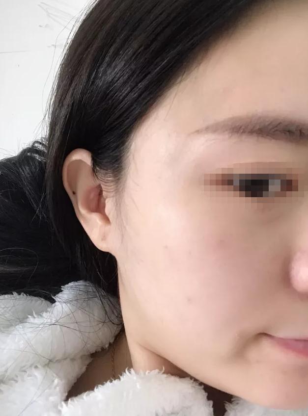 水光针是什么打了有什么作用,水光针如果停了会有什么影响