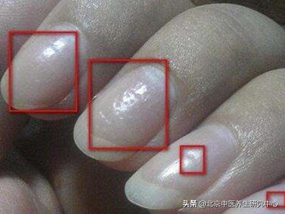 从手指指甲看出身体健康,指甲预示身体健康吗