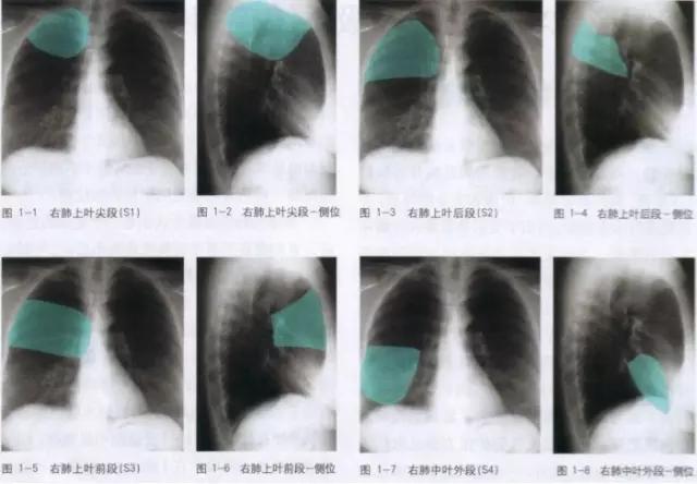 收藏：详细的胸部X线解剖，最基础最实用