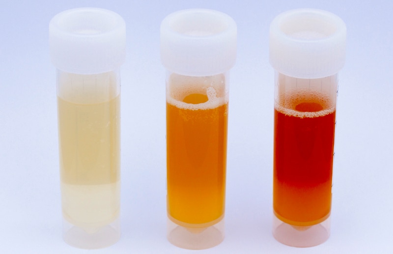 血尿可大可小？无症状≠平安无事！无痛血尿可能跟肿瘤相关