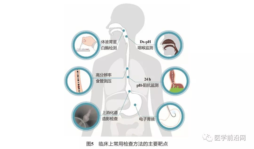 胃食管反流病误诊急性冠脉综合征,胃食管反流性咽炎会引起咳嗽吗