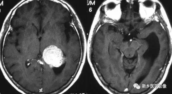 什么引起成人脑室扩大,哪些病可以导致左侧脑室增宽