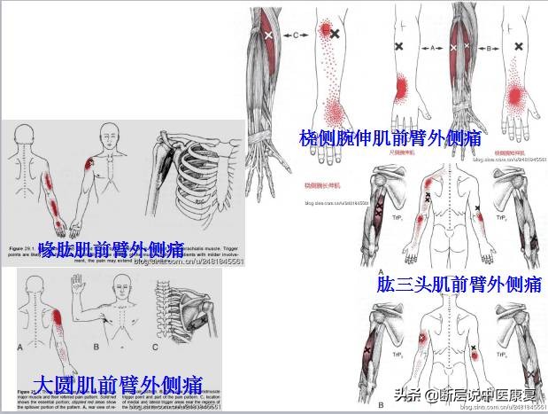 激痛点挂图,激痛点疗法笔记