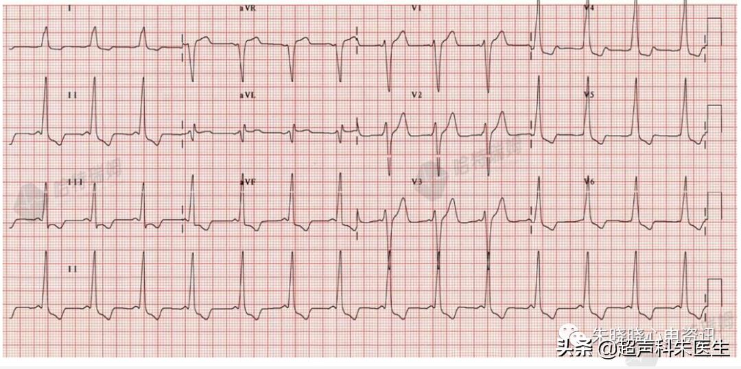 t波倒置诊断,t波倒置如何区分严重程度