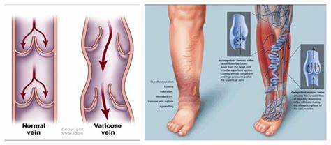 下肢静脉曲张出现皮疹用药,下肢瘙痒起疹子