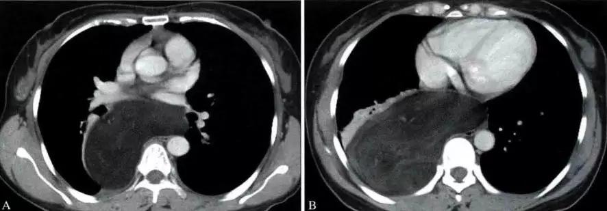 胸腺增生和纵隔肿瘤的区别和症状,纵隔胸腺肿瘤的常见临床症状表现