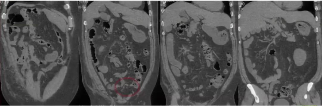 腹部ct详细讲解,腹部ct示意图及超详细教学
