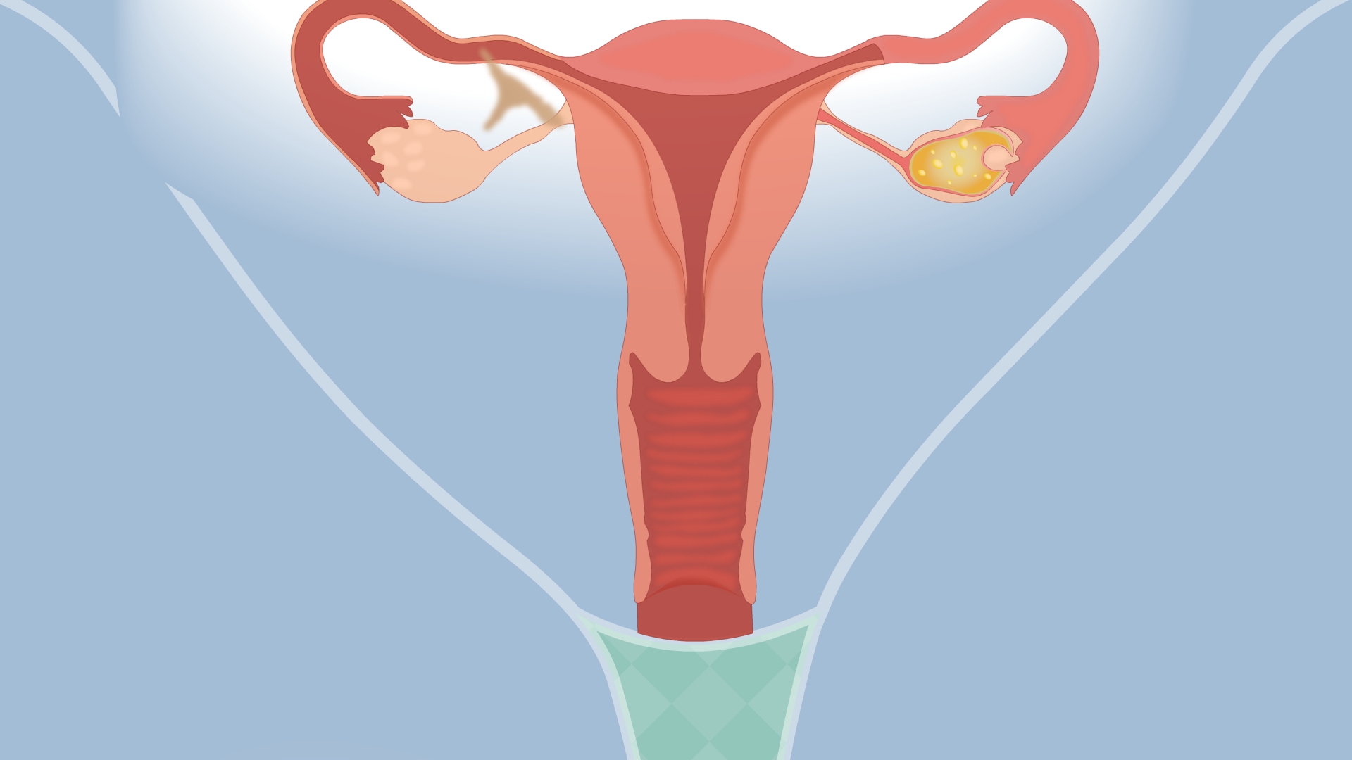 妇科过度清洁会怎么样,妇科炎症天天冲洗能好吗