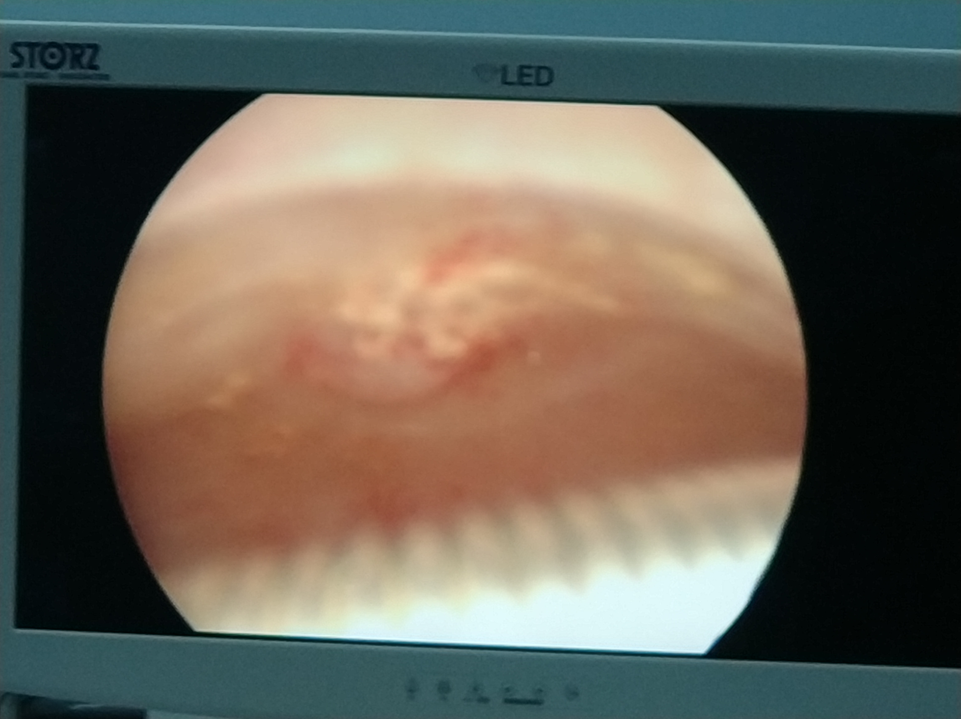 老年绝经女性朋友，B超提示宫腔积液，该何去何从