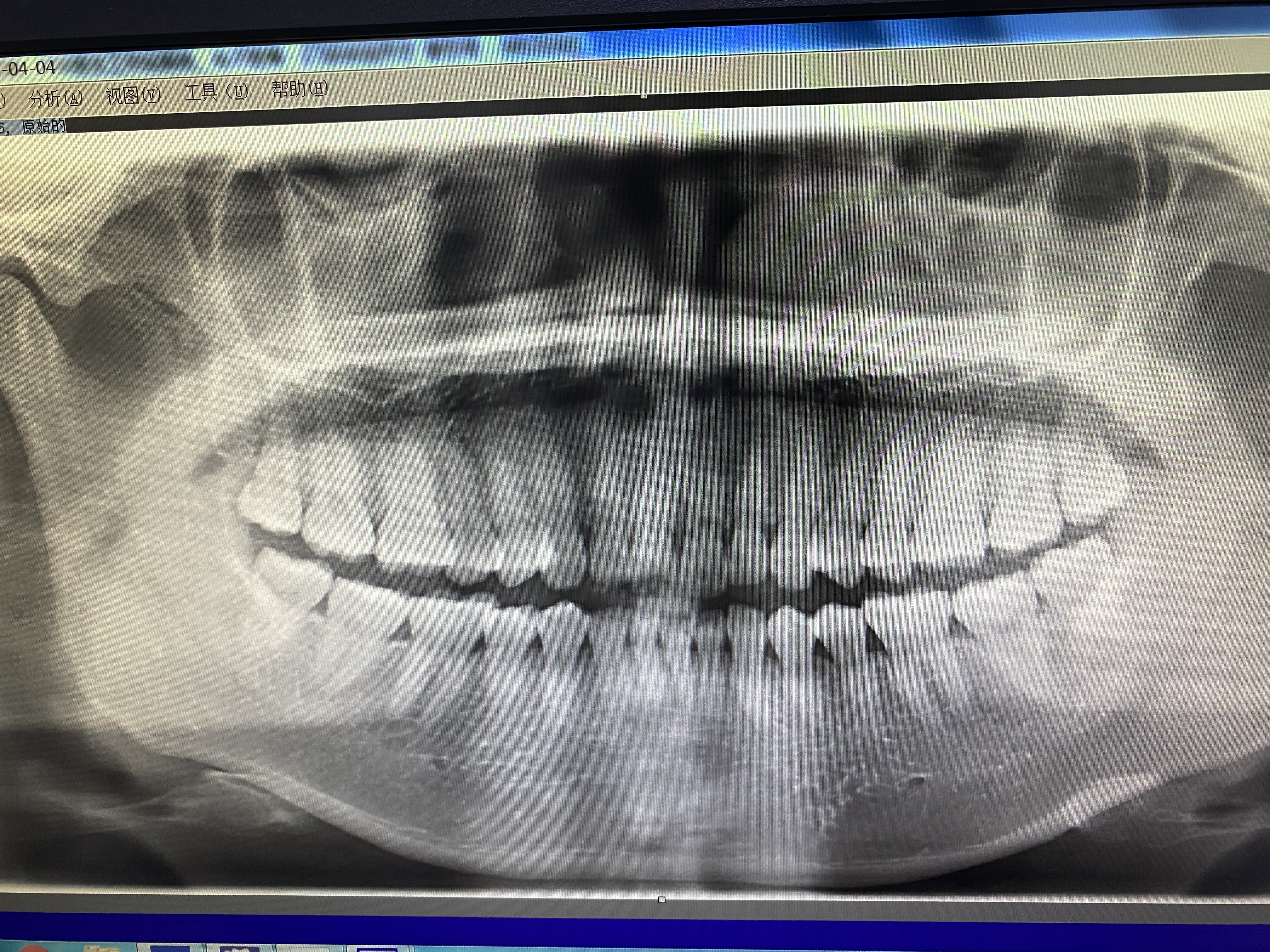 八天内拔了四颗牙,智齿掉了一大部分拔牙全过程
