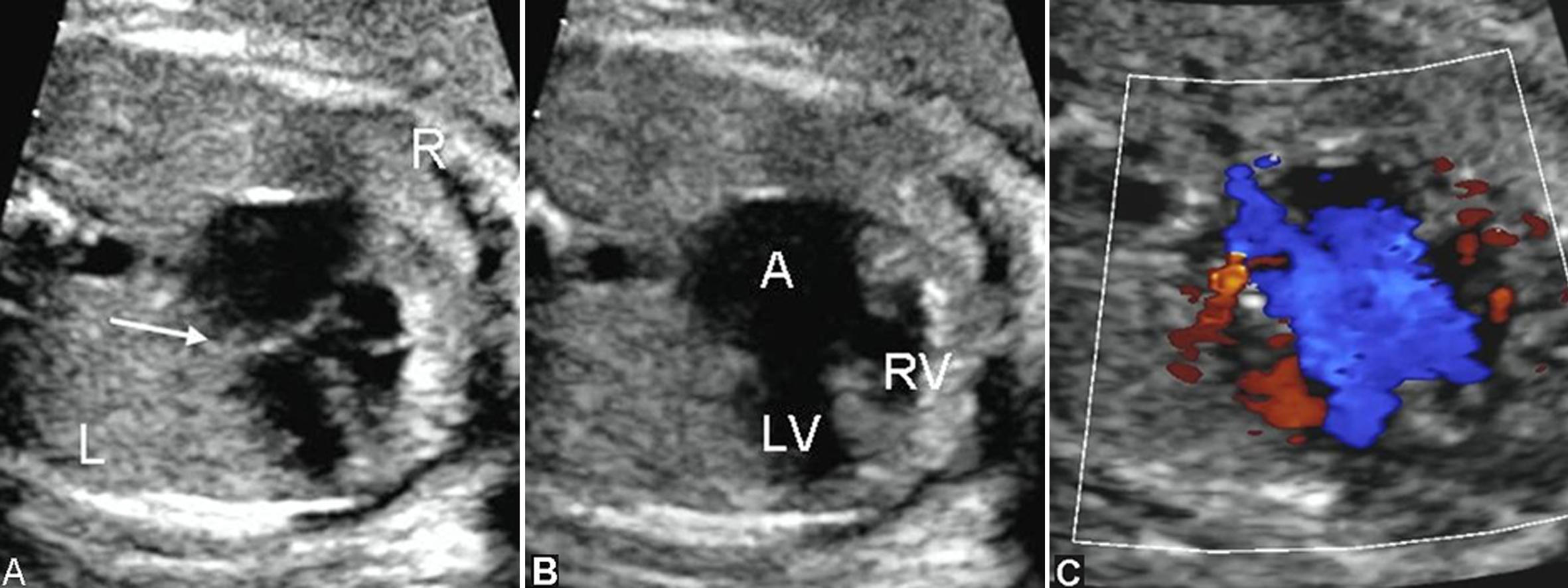 胎儿心脏发育异常微小室间隔缺损,胎儿心脏缺损1.3毫米严重吗