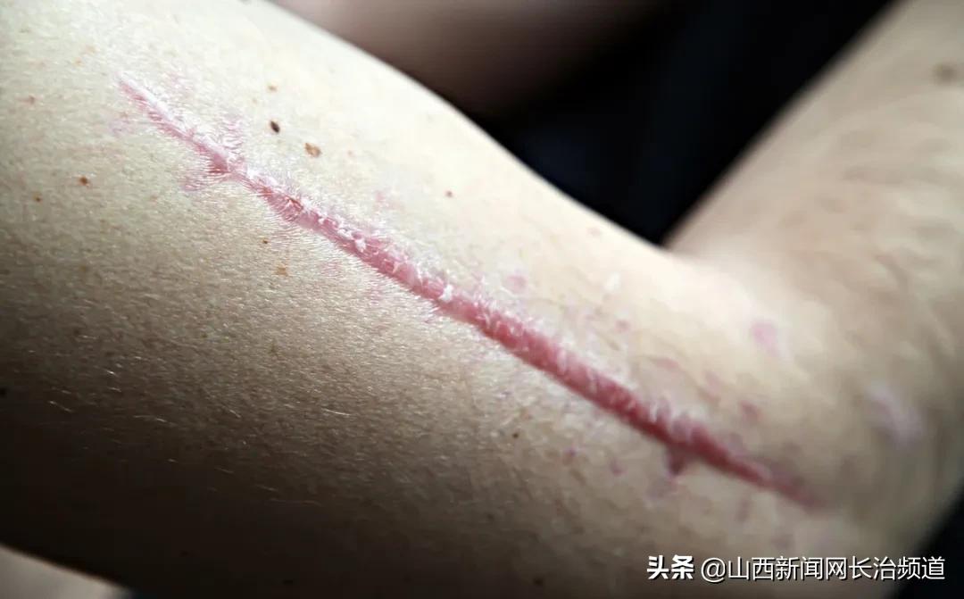 长治市伤疤激光修复,长治市第二人民医院祛疤