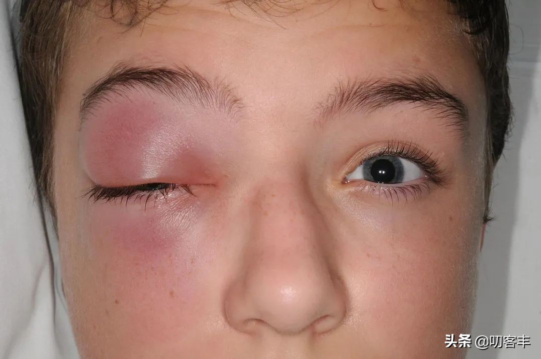 眼睛周围发红是啥原因,四岁女孩眼睛周围发红