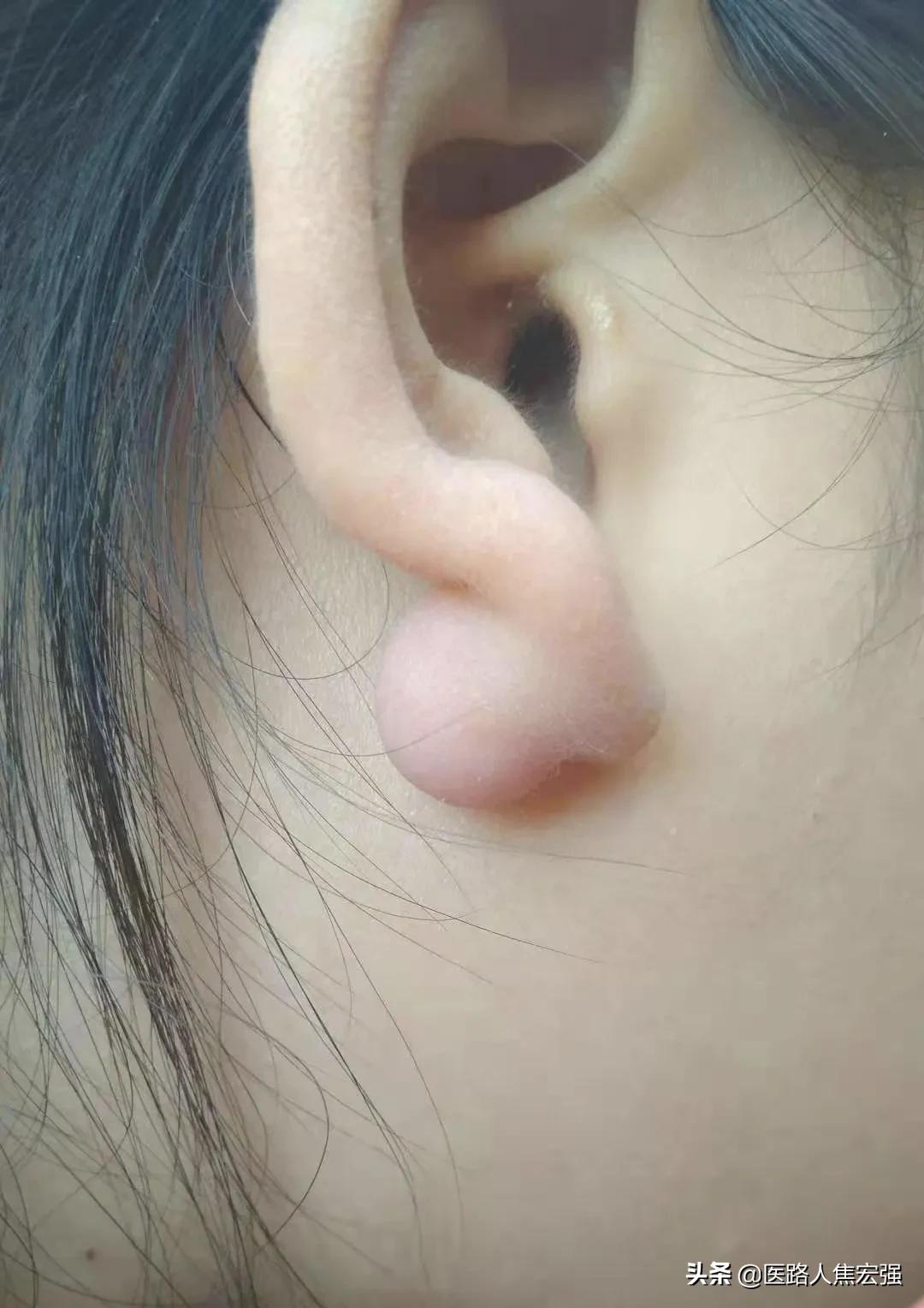 放疗对瘢痕的治疗作用,瘢痕放疗用的是什么射线