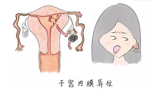 子宫内膜跑到卵巢里,子宫内膜跑了