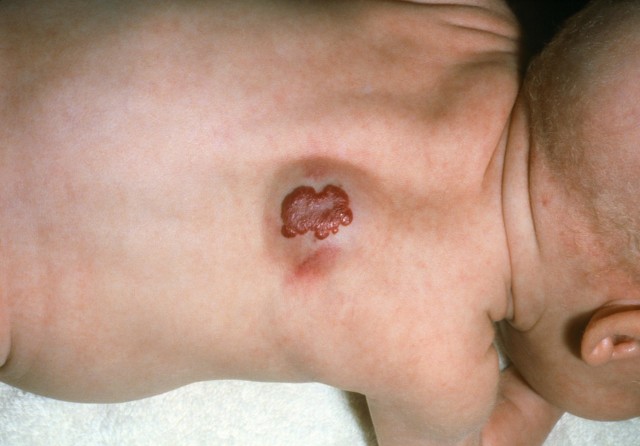 婴儿为什么有胎记,婴儿胎记大全图解