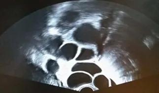 卵巢囊肿最大的克星,卵巢囊肿不可忽视的排卵障碍杀手