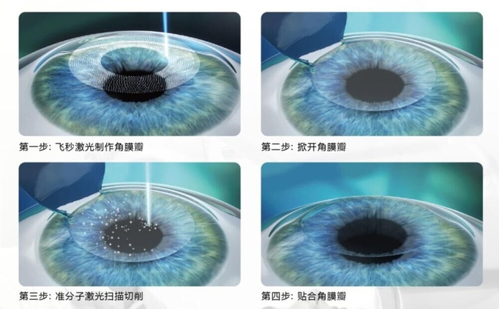 做半飞秒近视眼手术最坏的后果,近视眼手术最佳年龄和度数费用
