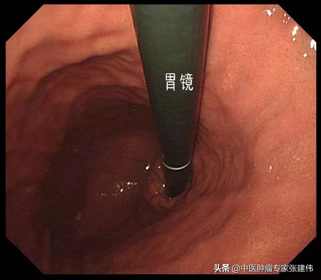 胃镜怎么看整个胃的情况,怎么知道做完胃镜对胃的损伤