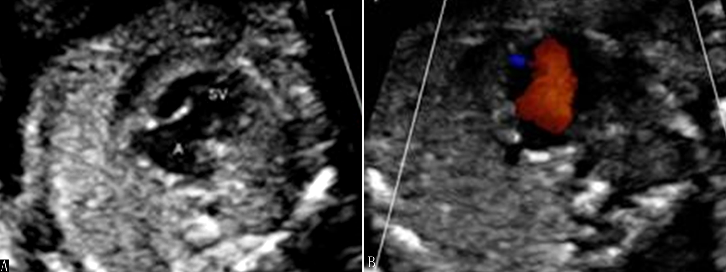 明明白白做超声26-4：胎儿心脏解剖结构异常-心室发育异常