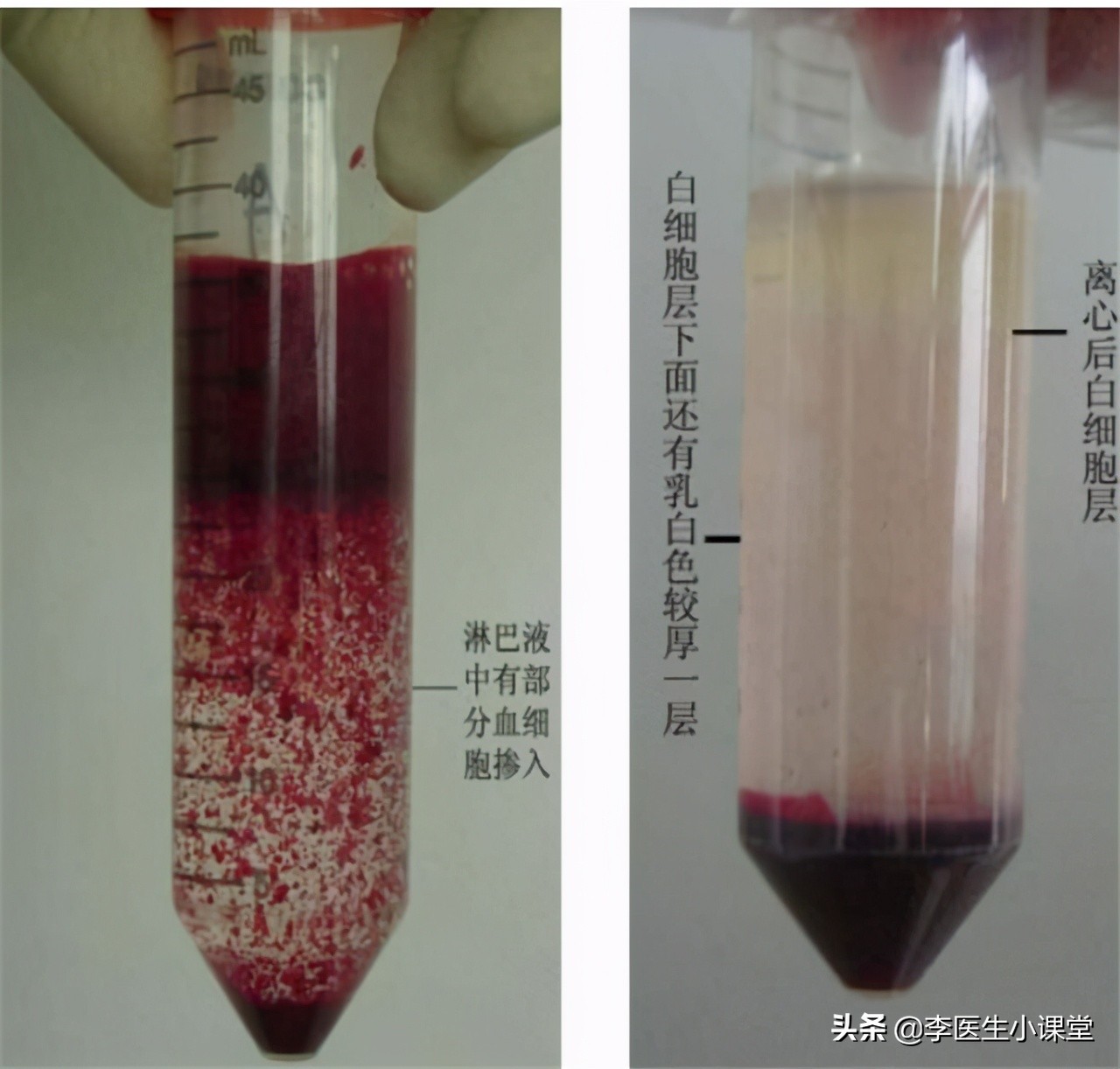 感染引起的淋巴结肿大怎么办,感染引起的恶性肿瘤