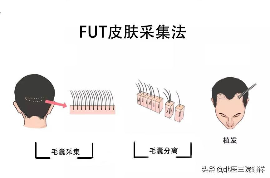 想要远离脱发远离八大误区,预防脂溢性脱发应避开这两大误区