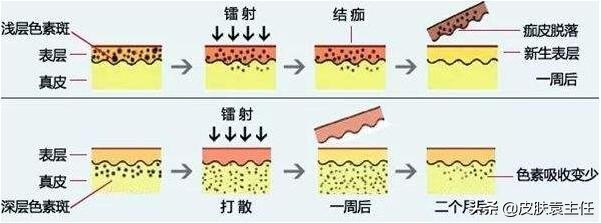 遮瑕遮不住雀斑怎么办,什么样的遮瑕可以遮掉雀斑