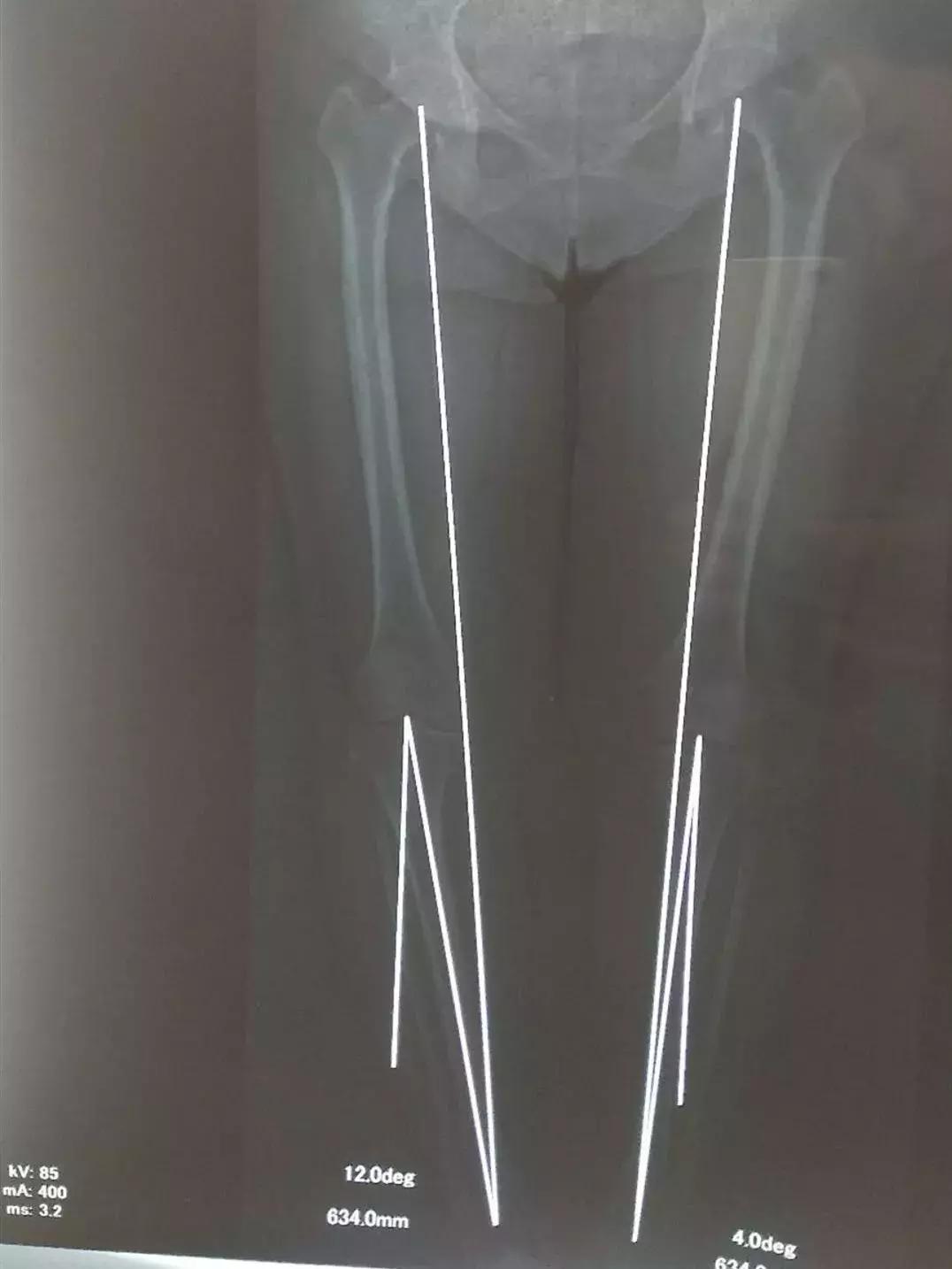 换膝盖关节手术有瘫痪风险吗,换膝手术可以百万医疗理赔吗