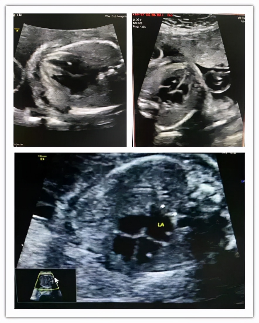 孕16周胎儿左心室有点状强回声,左心室点状强回声染色体异常概率