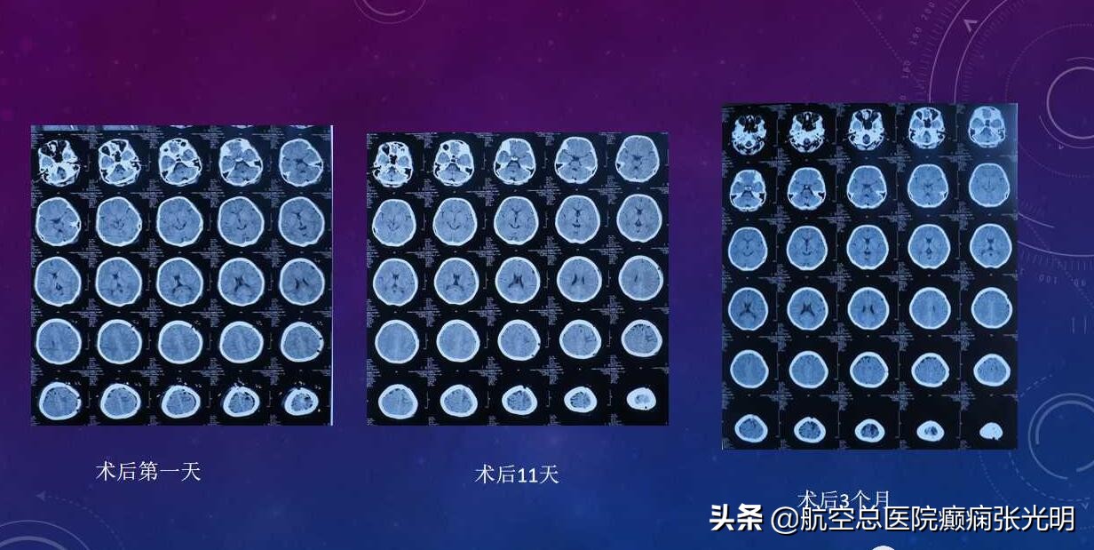 张光明左颞叶癫痫手术成功率,张光明谈治疗癫痫的方法有哪些