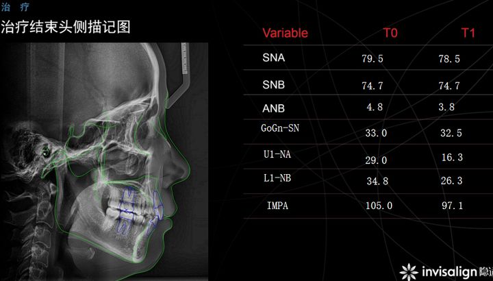 西安透明式牙齿矫正器龅牙,昆明牙齿矫正改变脸型