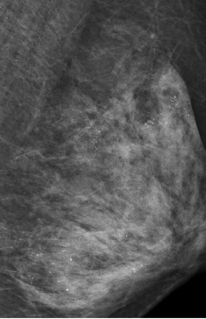 女子乳房布满“沙子”，不得已全乳切除！只因她常干的……