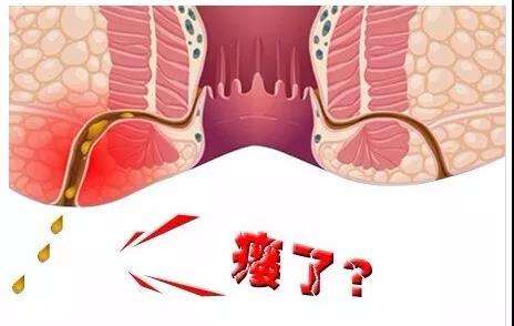 痔疮和肛瘘哪个严重一点,痔疮和肛瘘有区别吗哪个严重