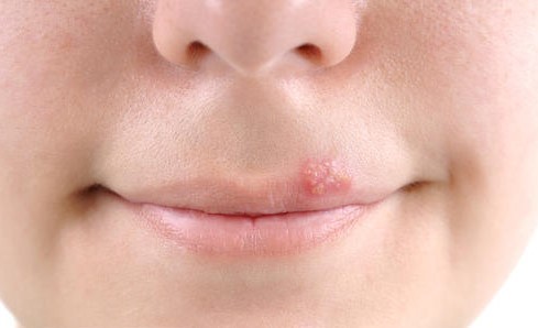 红霉素软膏多少钱有什么作用,几块钱的红霉素软膏淡斑