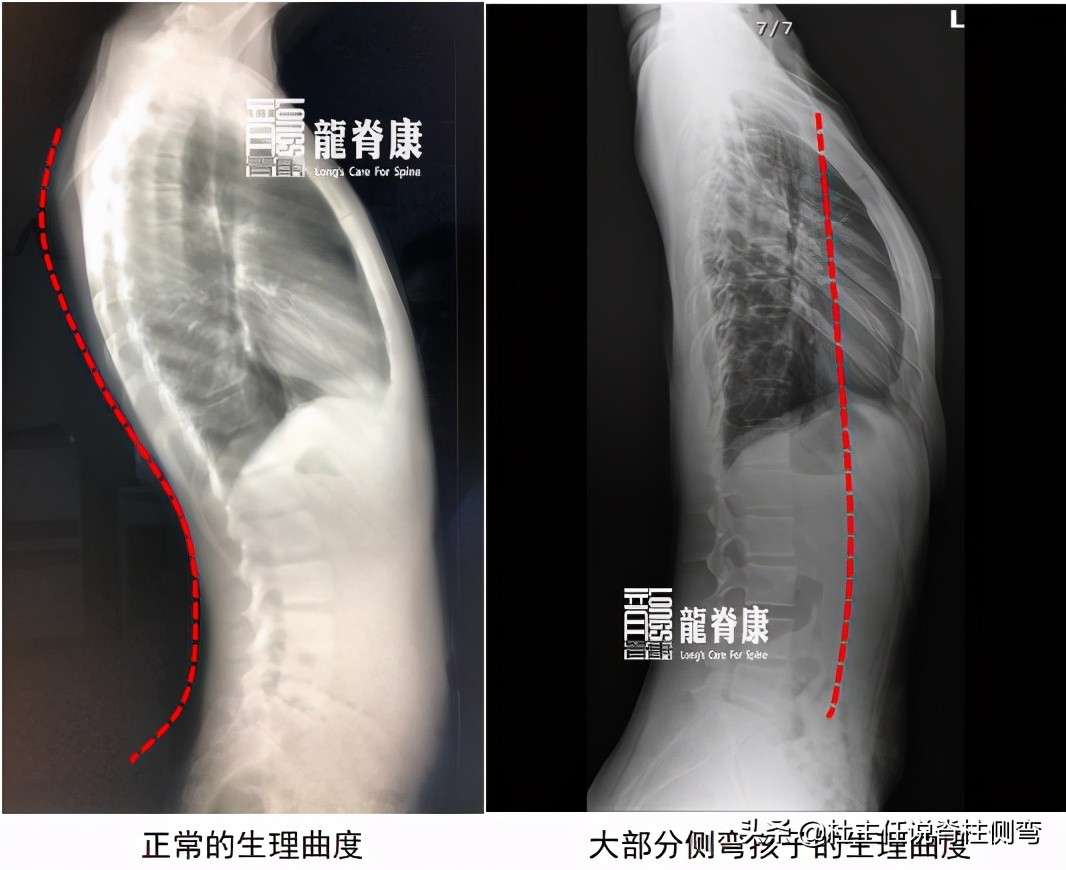 脊柱侧弯最好的恢复方法拉单杠,吊单杠可以纠正脊柱侧弯驼背吗