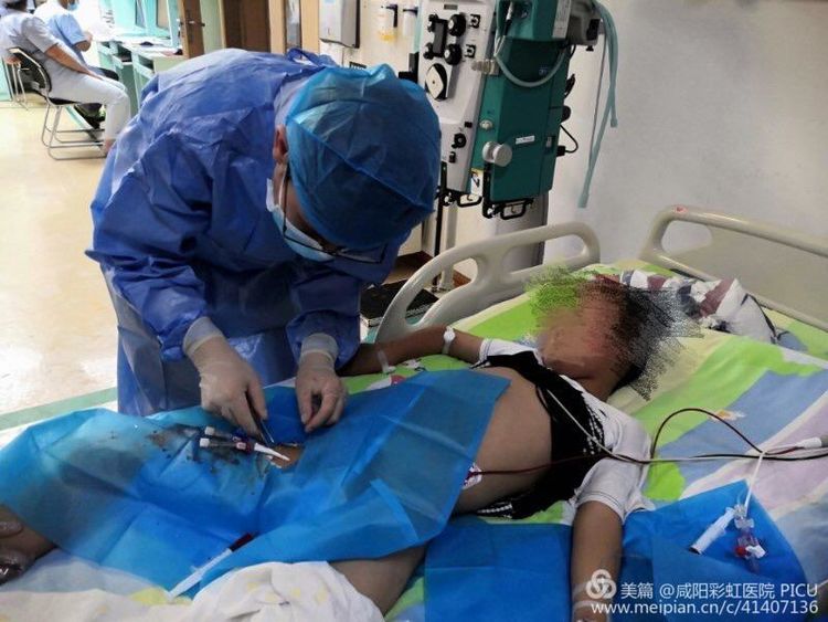 咸阳彩虹医院利用血液净化技术拯救出血热患儿