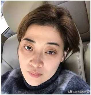 黑眼圈的类型及医美治疗方法,黑眼圈用什么方法拯救才好