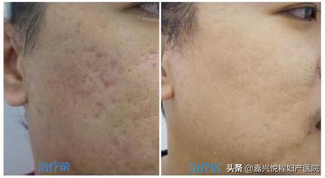 果酸是什么美容项目,能量果酸和果酸有什么区别