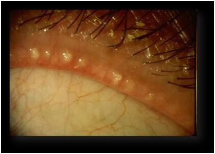 眼睛上长青春痘并且红肿怎么办,眼睛底下长青春痘