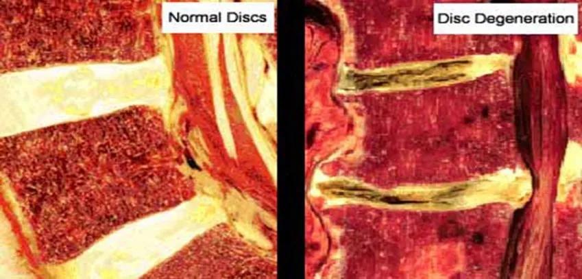 骨科专家讲解久坐的危害,每天做这个动作可以治愈腰椎