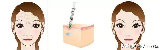 注射玻尿酸之前有什么注意事项,注射玻尿酸须知三件事