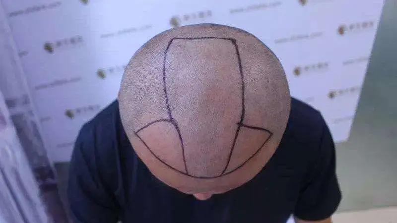 我才二十岁就秃头了该怎么办,我才20岁头发就要秃了