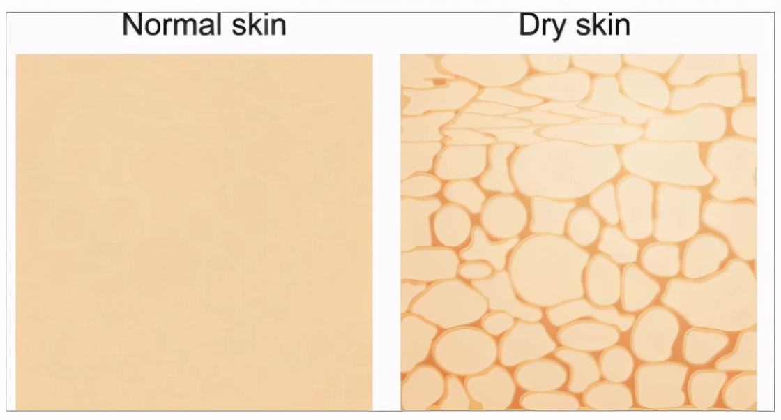 抬头纹和眼袋可以通过医美去掉吗,抬头纹很深医美上一般用什么填充