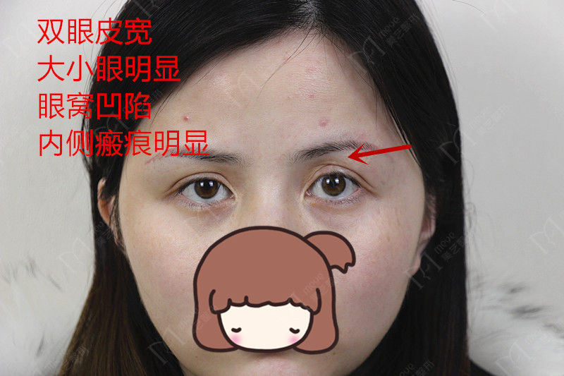 为什么有人割了双眼皮反而不好看,为啥有些人割了双眼皮变化巨大