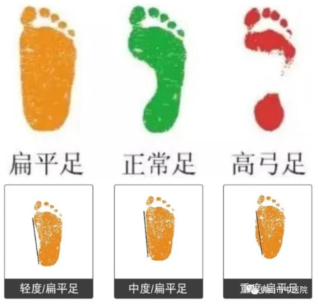 儿童扁平足的矫正训练,儿童矫正扁平足的最佳锻炼方法