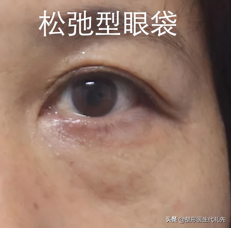 眼袋遗传的原因,眼袋大最简单手术去眼袋的方法