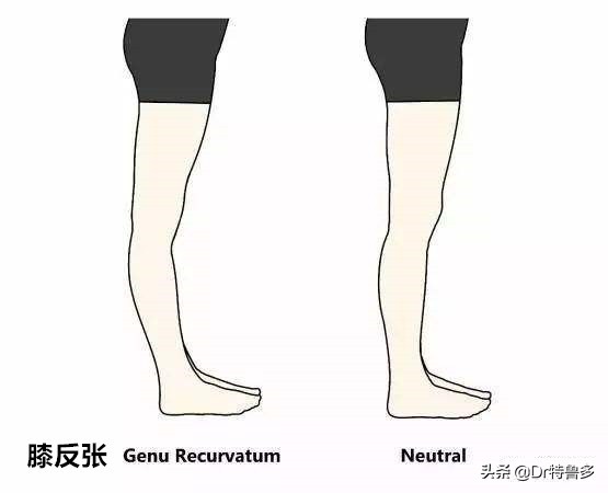 膝盖疼应该知道的几件事,膝眼痛考虑何病