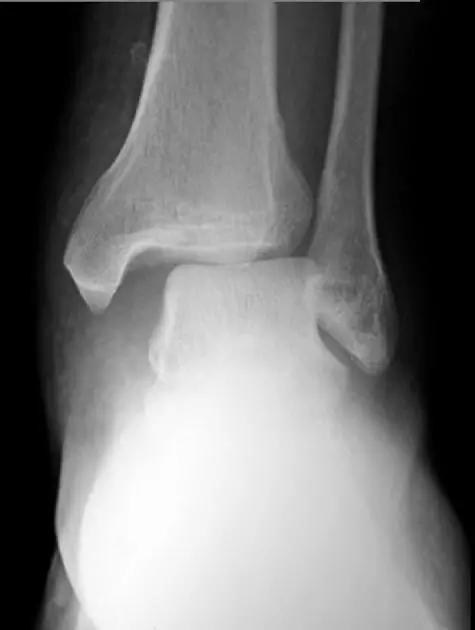 几种严重骨折医学名称,常见的骨折有哪些名称