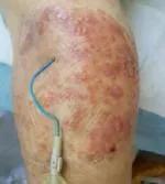 地塞米松新用途：轻松搞定医用胶粘剂相关性皮炎